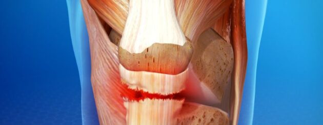 Snapped tendons: What to do straight away and where to seek help