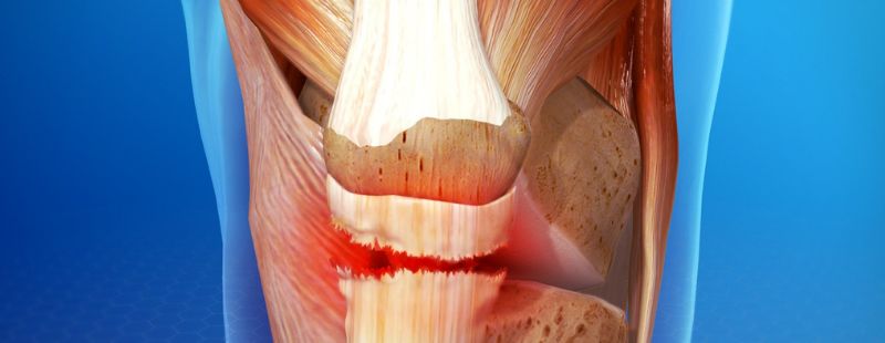 Snapped tendons: What to do straight away and where to seek help