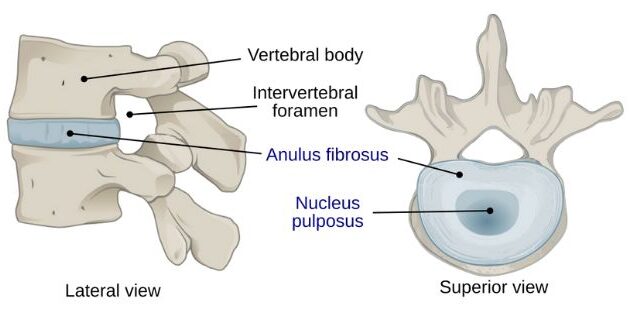 Bulging Discs & What to do about them.