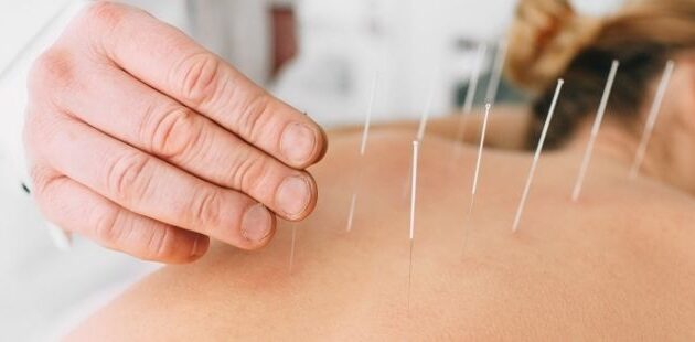 Acupuncture and dry needling